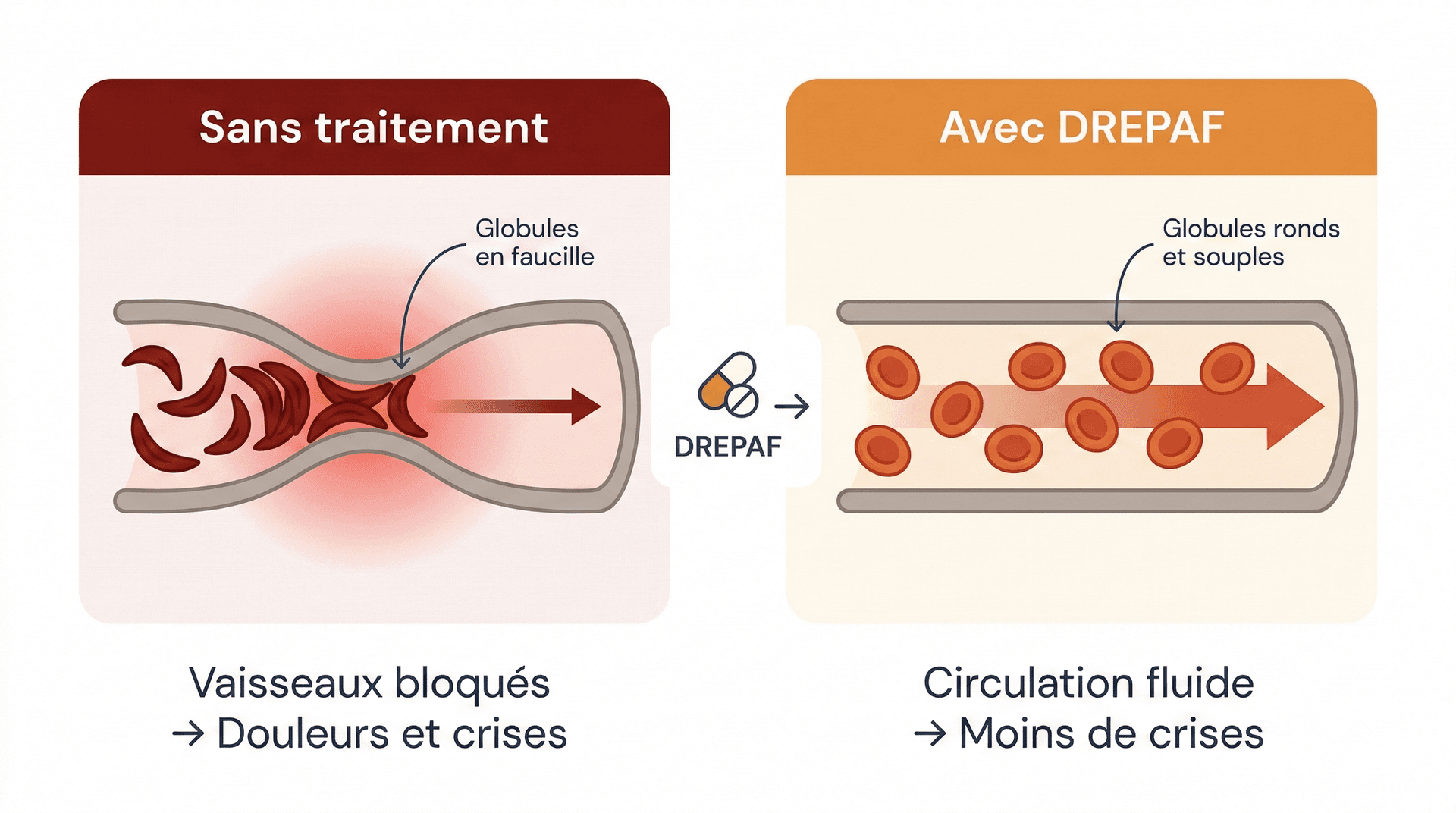 Schéma comparatif avant/après traitement DREPAF : sans traitement, les globules en faucille bloquent les vaisseaux causant douleurs et crises ; avec DREPAF, les globules ronds et souples circulent librement, réduisant les crises